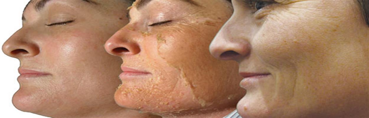A chemical peel is a technique used to improve the appearance of the skin o...